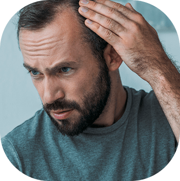 Alopecia