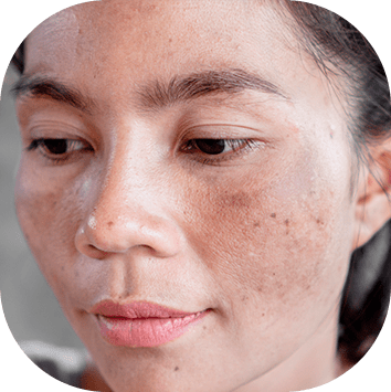 Melasma