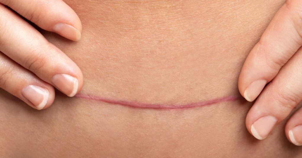 Cicatriz pós cirurgia plástica: o que fazer mês a mês
