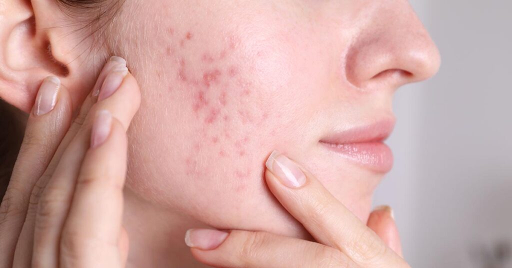 Por que tenho acne aos 30 anos? 6 causas principais