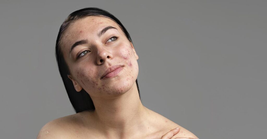 Por que tenho acne aos 30 anos? 6 causas principais