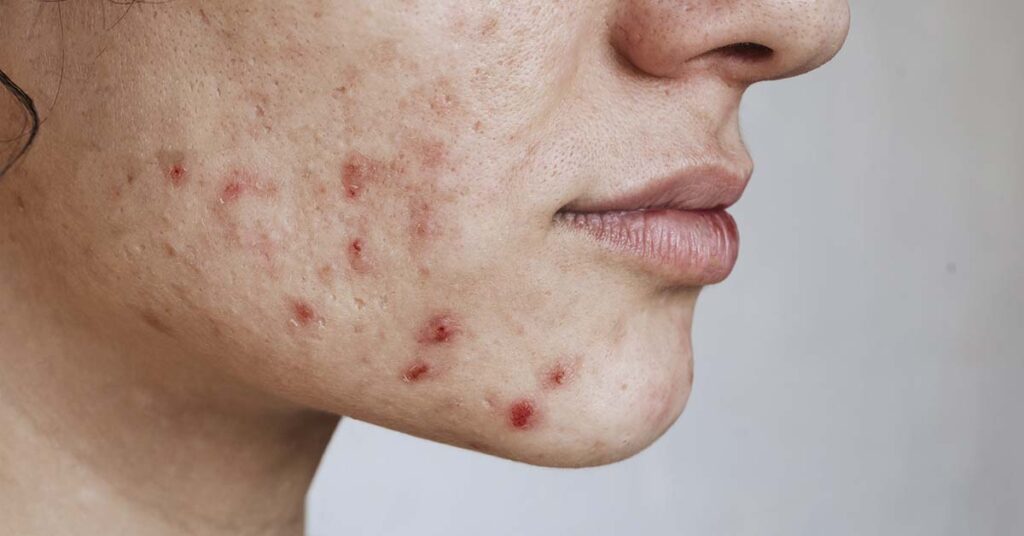 4 tipos de acne: descubra como identificar o seu em 2 minutos
